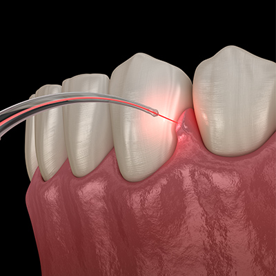 Benefits of Laser Surgery