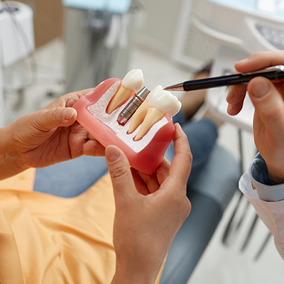 Cost of Dental Implants