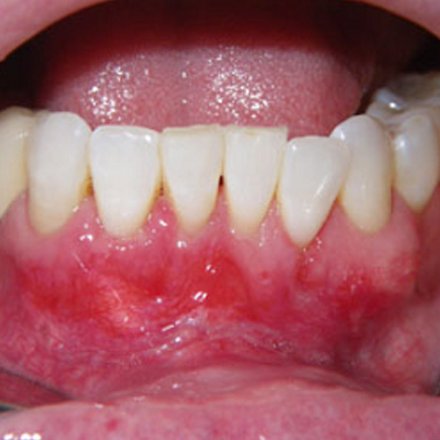 ​​​​​​​Pinhole Surgical Technique™