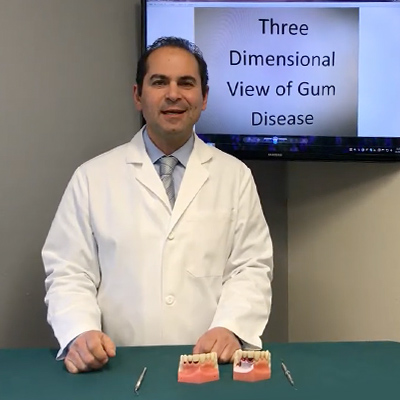 ​​​​​​​Gum Disease Stages