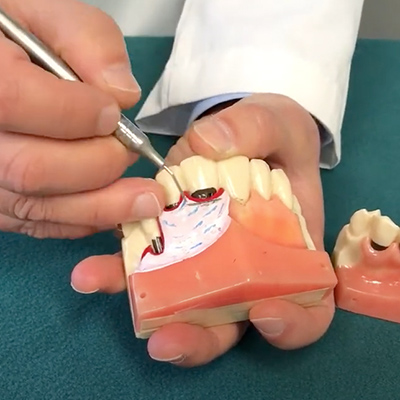 Treatment for Receding Gums